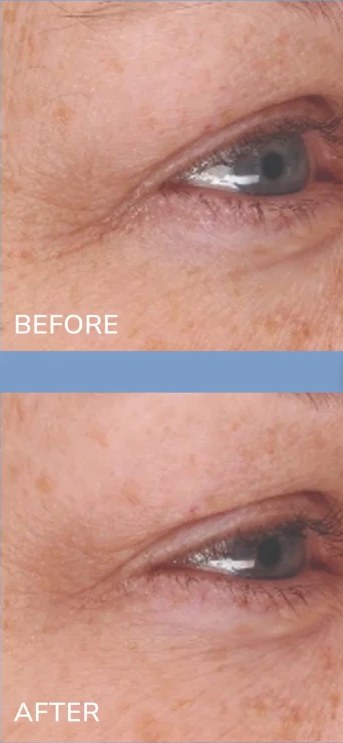 Official SeneGence before and after clinical study photos of the eye area